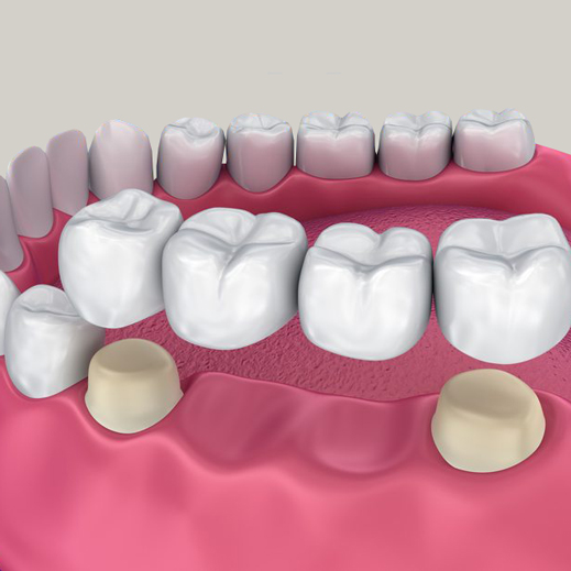 Types of dental bridges